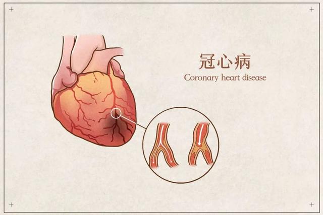 国医大师雷忠义：从痰瘀毒风治胸痹心痛