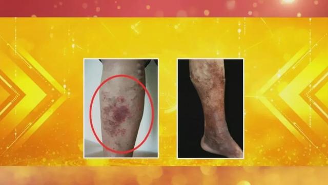 对称红斑角化症为什么发红