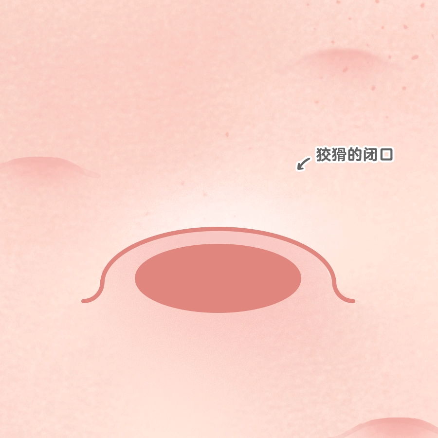 角化囊肿为何不能一次切除