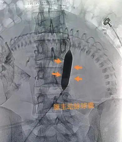 「传真」小球囊化身“安全锁”高危产妇分娩不再“浴血奋战”