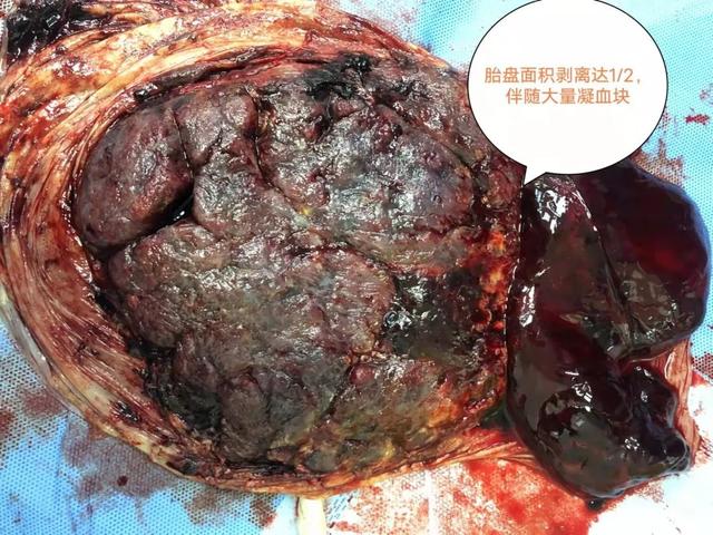 二胎妈妈突发胎盘早剥，多学科展开生死营救