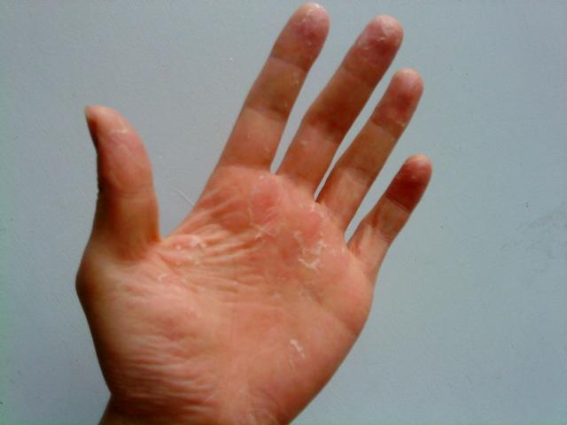 手脱皮怎么治疗好（手上老是脱皮怎么办）