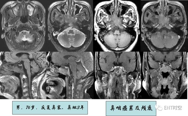 鼻咽鳞状上皮增生伴不全角化