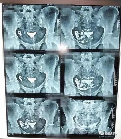 说说41岁高龄二胎妈妈的我艰辛求子之路