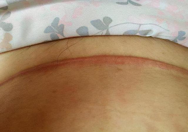 剖腹产刀口增生有什么影响？