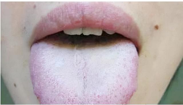 舌苔厚腻就是上火吗