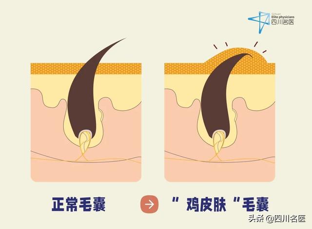 鸡皮肤好去除吗