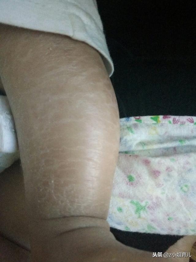 每次冬天皮肤起鸡皮疙瘩