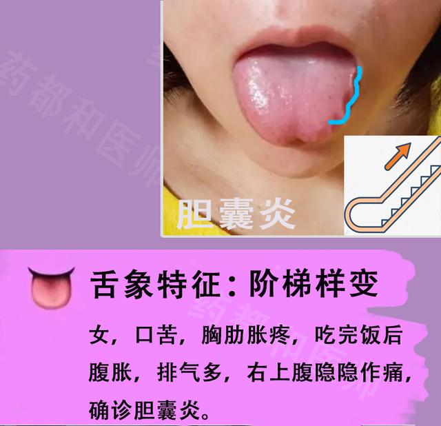 胆囊息肉，胆结石，肝囊肿？6种肝胆病变，看看舌象就知道