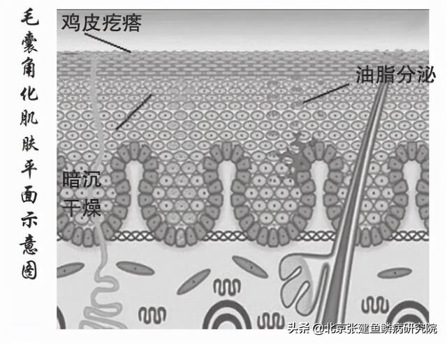 腿上毛囊角化症图片