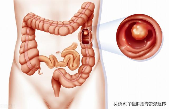 腸息肉一定要割了？醫生：越拖越危險，90%的大腸癌是它引起的