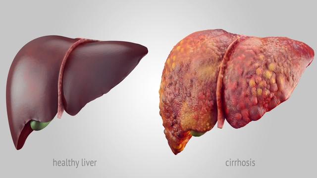 吃补肝药、药酒、维生素保肝养生？当心越补越伤肝肾，你还在用吗