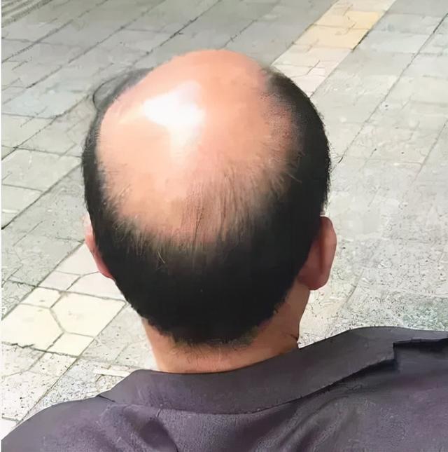 为什么你比别人掉发多、秃头顶？原来和这3种营养问题有关