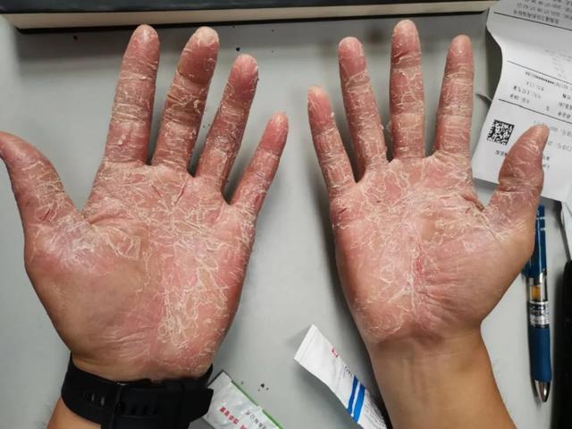 慢性角化性湿疹中医治疗