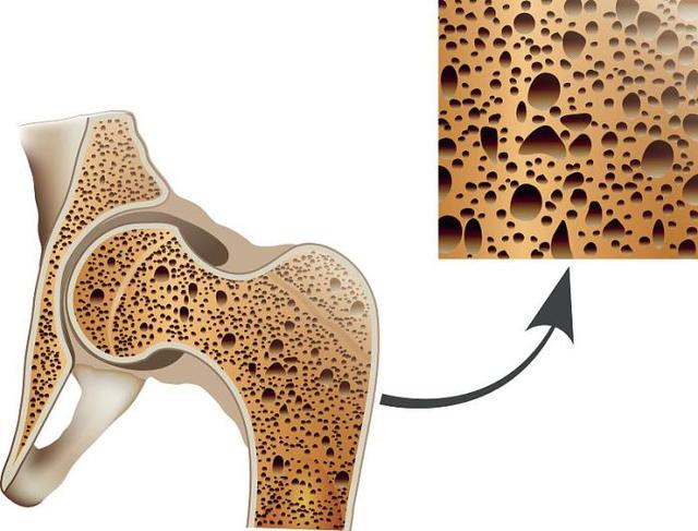 为何天天喝奶还是患上骨质疏松，为什么天天喝牛奶、吃钙片，还容易得骨质疏松你可能不了解真相