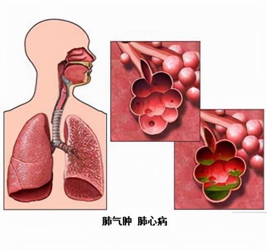 肺不好，为啥心脏会出问题？如何治疗肺心病？