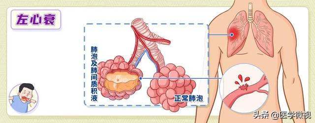 咳嗽、咳痰竟还可能与心脏病、胃病有关？