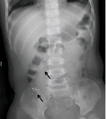 孩子咬破体温计，吞下水银，怎么办？