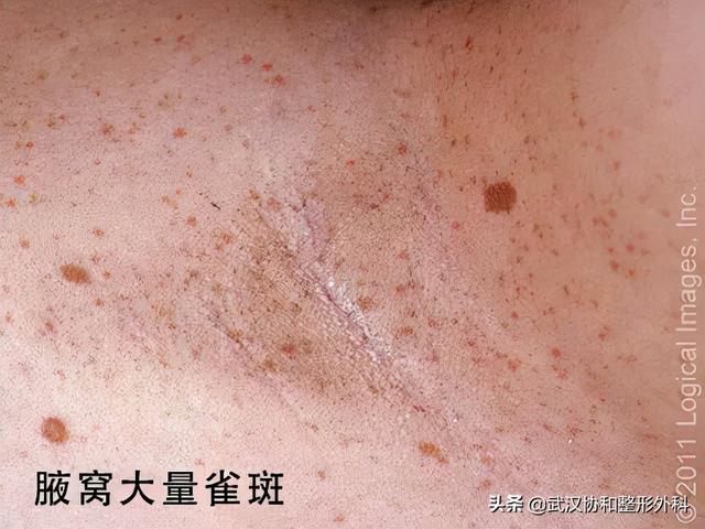 是“疾”不是“记”！警惕宝宝身上的“咖啡牛奶斑”