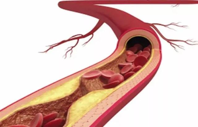 血脂异常，危害到底有多大？