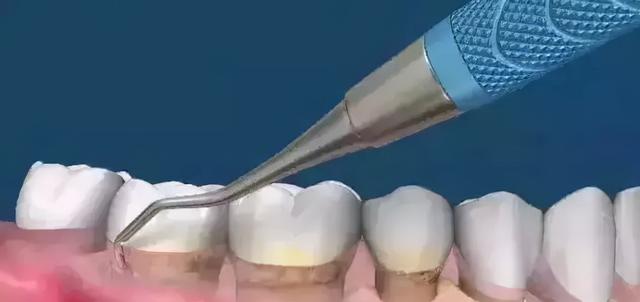 洗牙大概要多少钱（洗牙普通200深度3000，有什么区别）