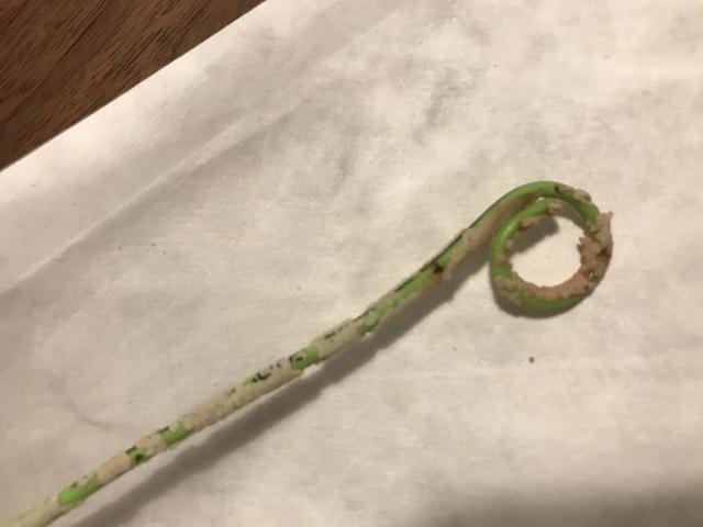 这根脏脏的管子上面，是我怀孕期间积累的结石