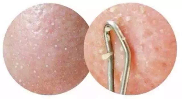 毛囊角化里面挤出来是白色的吗