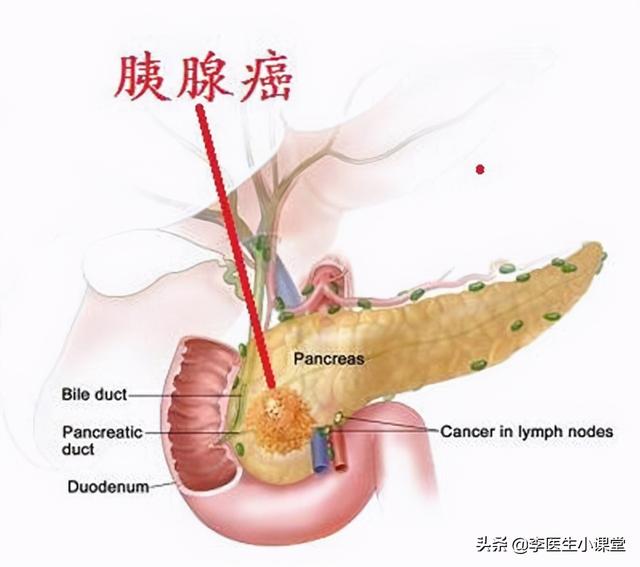 胰腺癌检查薄层核磁是什么意思