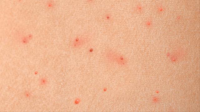 鸡皮肤能激光消除吗