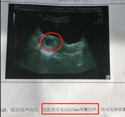 孕早期孕囊图片（孕早期孕囊图片怎么看）