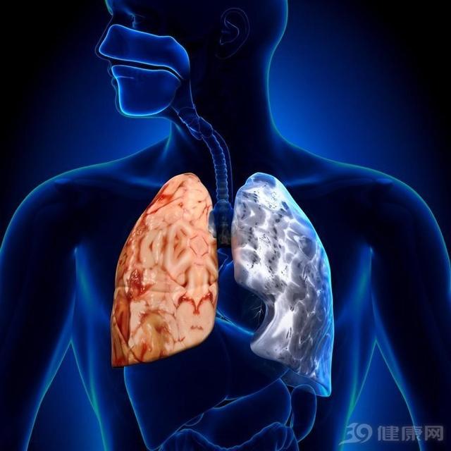 肺炎:来势汹汹,取命匆匆!5大症状,老年人尤其要留意