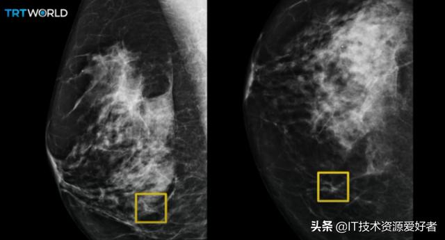 能检测乳腺癌，还能让渐冻症患者“开口说话”，谷歌这次有点东西