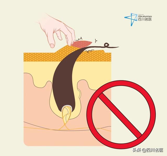 脸毛周角化