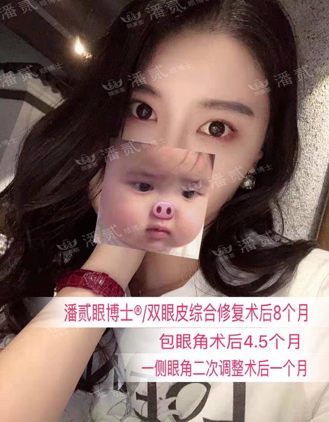 開了眼角後悔不已的案例 內眼角過大 露紅 括號 疤痕重 顯假 Kks資訊網