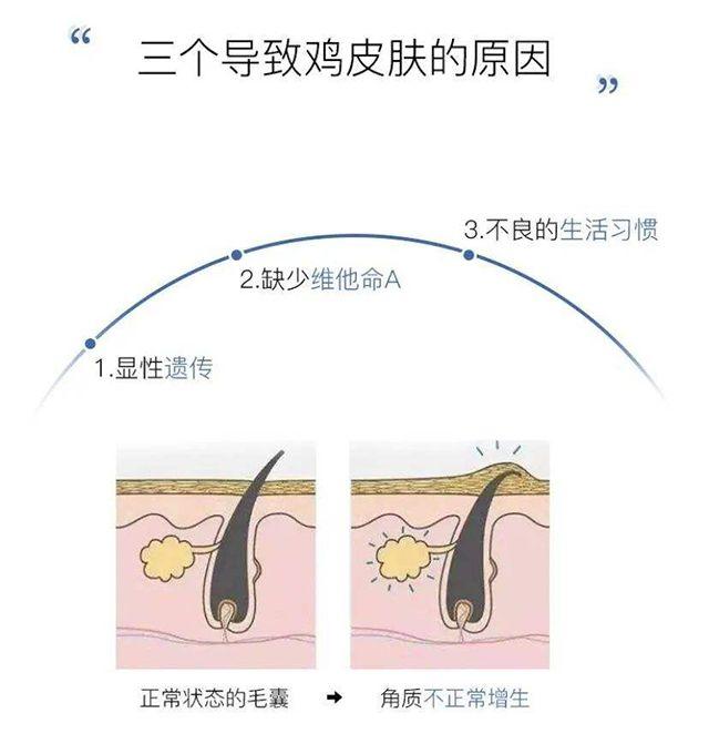 什么程度的鸡皮肤可以刷果酸