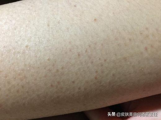 果酸可以治疗鸡皮肤吗