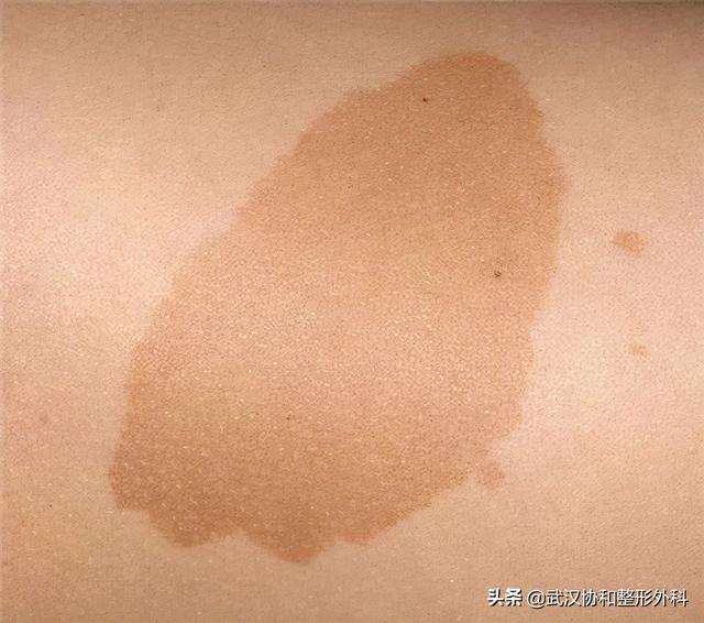 是“疾”不是“记”！警惕宝宝身上的“咖啡牛奶斑”