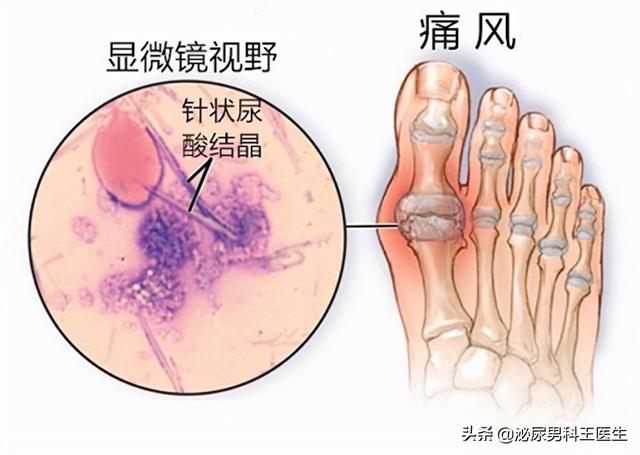尿酸高，如何让尿酸排出体外？医生总结：3个办法，实用又有效
