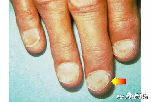 食道癌部分角化