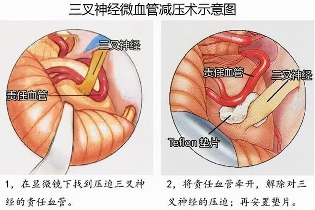 “风吹草动”皆可引发这种剧痛——得了三叉神经痛千万不要再忍了