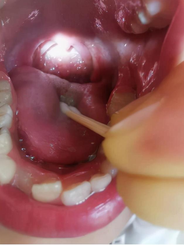 导致孩子过敏的罪魁祸首——肠漏症