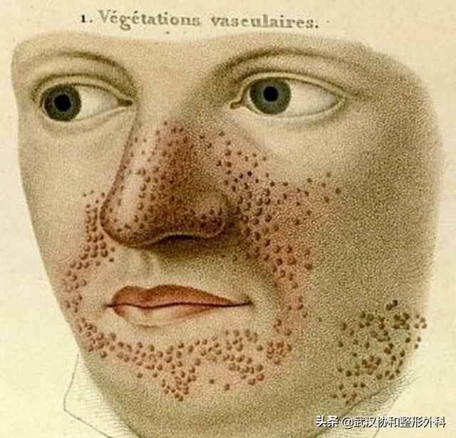 是“疾”不是“记”！警惕宝宝身上的“咖啡牛奶斑”