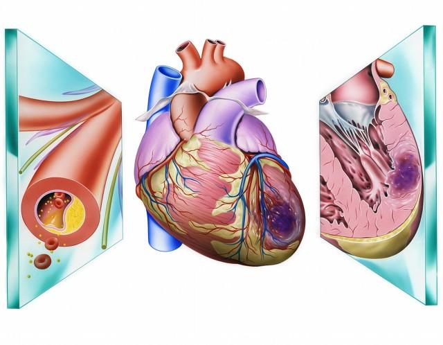 麝香保心丸，增加冠脉供血抗心绞痛，促进心肌血管再生，保护心脏