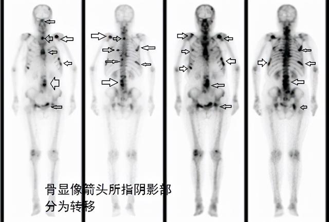 什么樣的疼痛應該小心是骨轉移？
