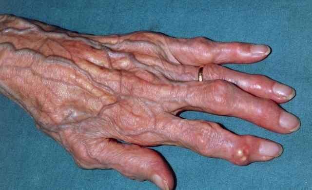 得了痛风最怕长出痛风石，该怎么避免呢？