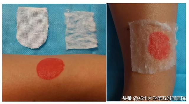 治疗宝宝的“红胎记”，您做对了吗？