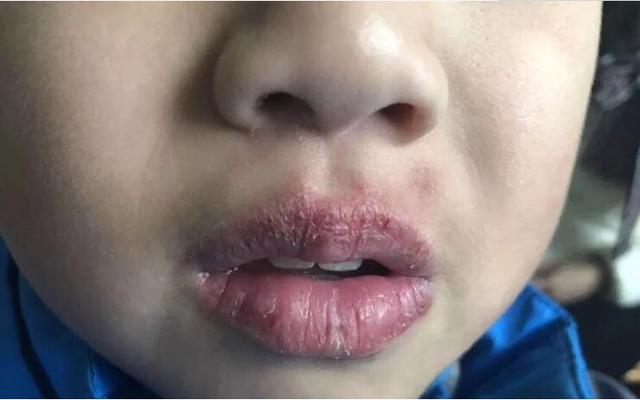 宝宝嘴裂出血了怎么办