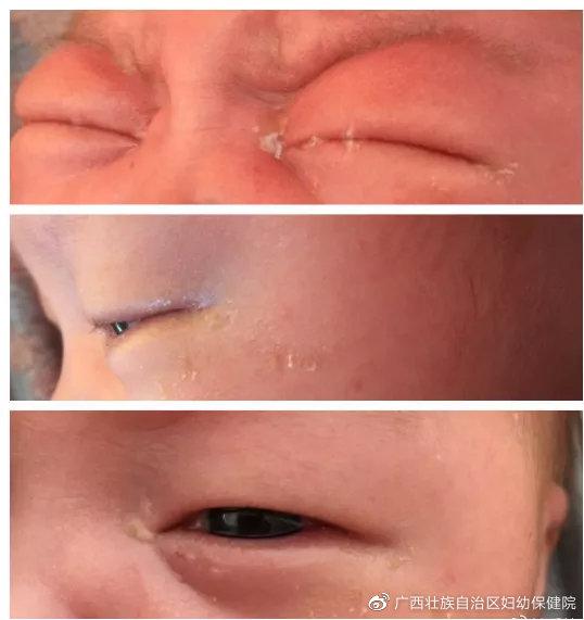 婴儿泪囊炎的症状图片图片