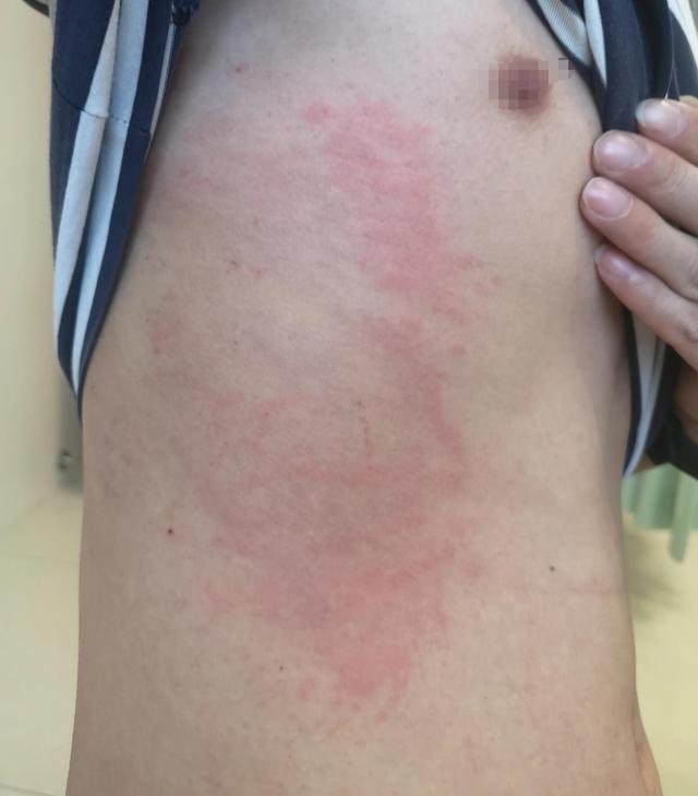 屁股出汗红色一片疙瘩角化