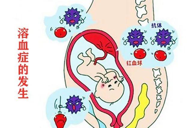 夫妻溶血检查是什么意思